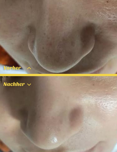 Vorher-Nachher Ergebnis Hydrafacial Stuttgart mit reiner Haut