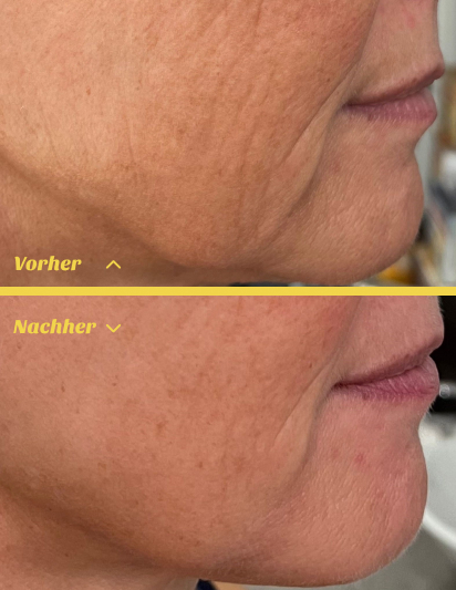 Radiofrequenz Microneedling Behandlung für straffe Haut in Stuttgart