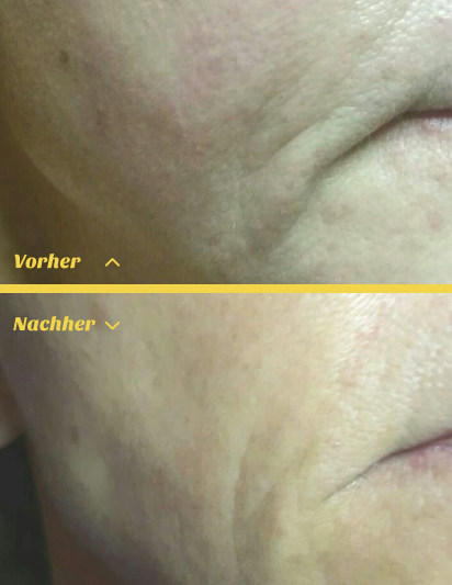 Hautverjüngung durch Radiofrequenz Microneedling im Kosmetikstudio Stuttgart Mitte